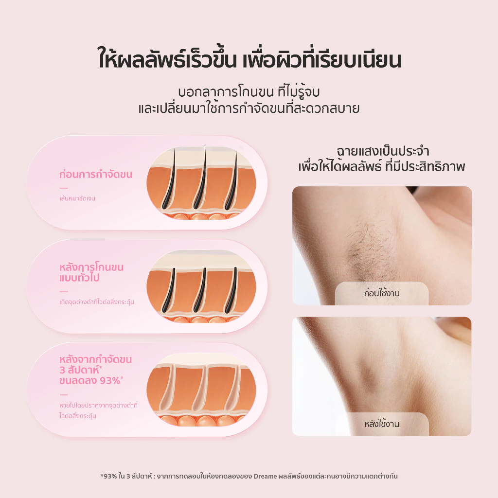 Dreame Sapphire IPL Hair Removal 21J เครื่องเลเซอร์กำจัดขนแบบ IPL Ice-Cooling 8 ระดับ ปกป้องผิวจากความร้อน
